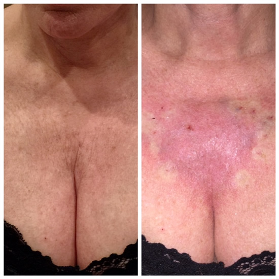 PDO Thread treatment before and after showing chest area.