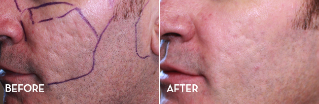 Acne Scar Treatment Results Before and After | La Fontaine Aesthetics
