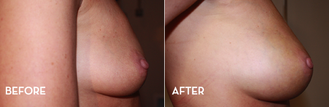 Breast Enhancement Before and After | La Fontaine Aesthetics