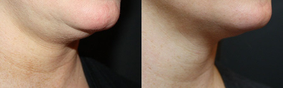 Coolsculpting Before and After | La Fontaine Aesthetics