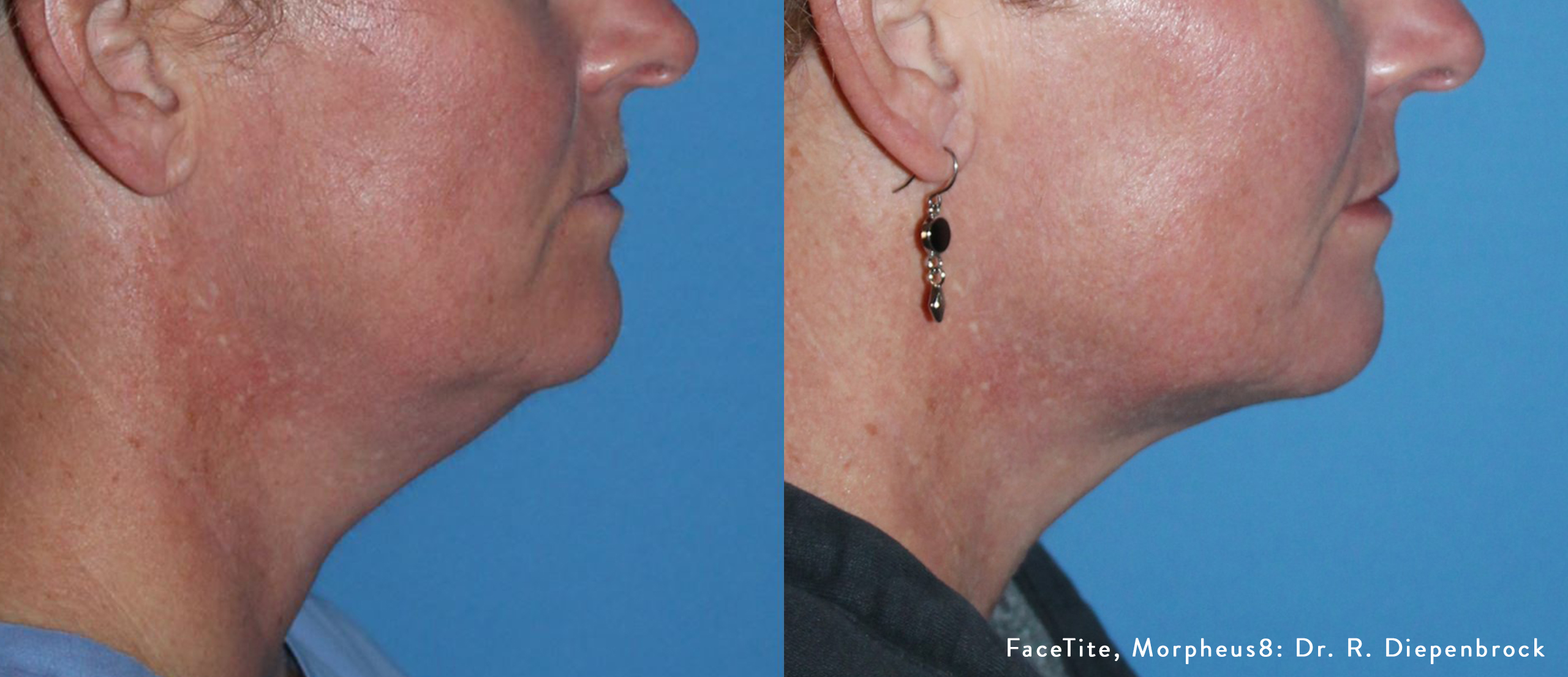 Facetite Before and After | La Fontaine Aesthetics