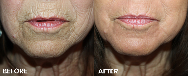 Laser Skin Resurfacing Before and After | La Fontaine Aesthetics