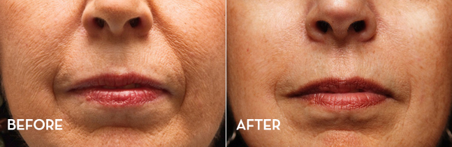 Smile Lines Before and After | La Fontaine Aesthetics