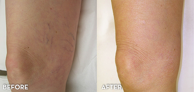 Before and after spider vein treatment at La Fontaine Aesthetics in Denver