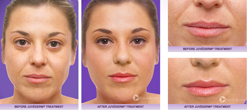 Juvederm Injections Before and After Pictures 7