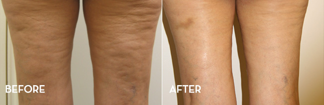 Cellulite Leg Thigh cellulite accent xl